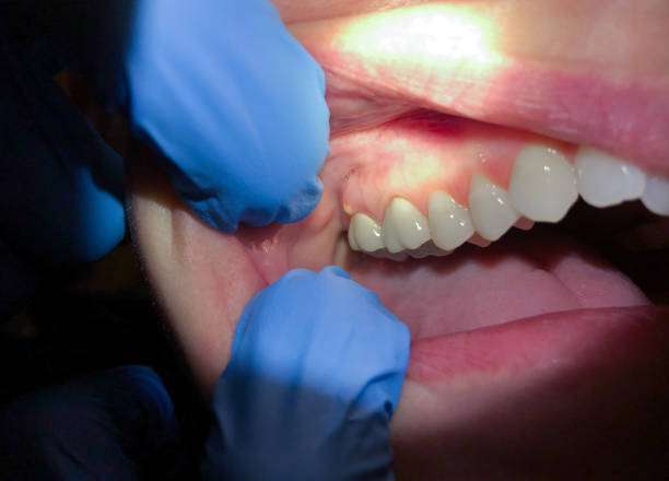 Best Emergency Tooth Extraction in Old River Winfree, TX