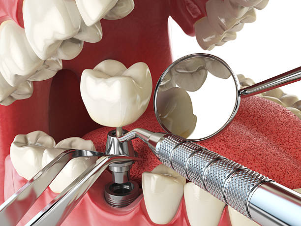 Best Emergency Tooth Extraction in Old River Winfree, TX